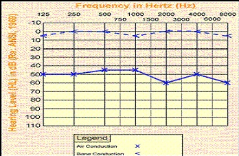 conductive-hl-audiogram