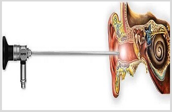 endoscopic-ear-visualisation