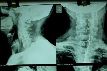 Barium Swallow