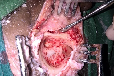 Mastoidectomy Cavity