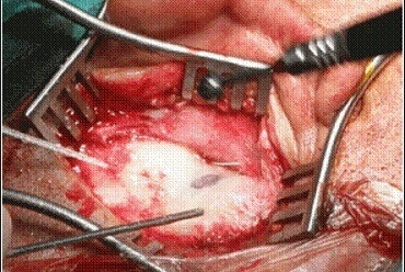 Mastoidectomy